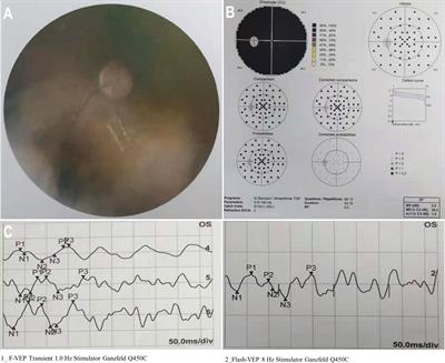 Sinonasal diffuse large B-cell lymphoma in a patient with Wiskott–Aldrich syndrome: A case report and literature review